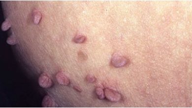راه های انتقال HPV چیست؟